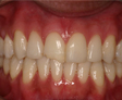 Blanqueamiento Dental