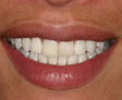 Blanqueamiento Dental