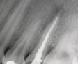 Endodoncia Dental