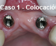 Implante Dental