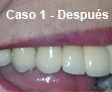 Implante Dental