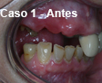 Implante Dental