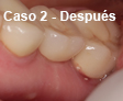 Implante Dental