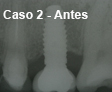 Implante Dental