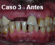 Implante Dental