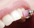 Limpieza dental