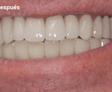 rehabilitacion Oral
