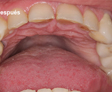 rehabilitacion Oral