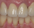 rehabilitacion Oral
