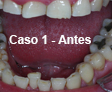 Restauraciones Estéticas