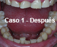 Restauraciones Estéticas