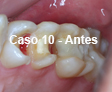 Restauraciones Estéticas