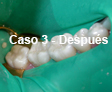 Restauraciones Estéticas
