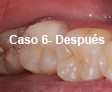 Restauraciones Estéticas