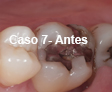 Restauraciones Estéticas