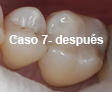 Restauraciones Estéticas