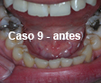 Restauraciones Estéticas